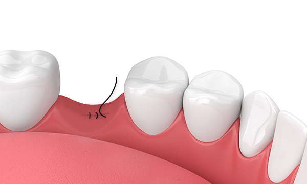 Снятие шва на слизистой оболочке полости рта