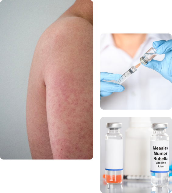 Осложнения после вакцинации от краснухи