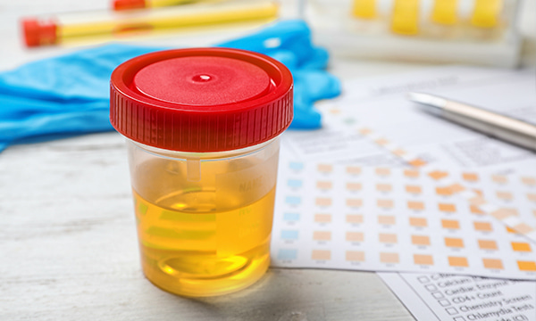 Исследование уровня альбумина и креатинина в моче (микроальбуминурия, альбумин/креатининовое соотношение, разовая порция) Исследование уровня альбумина и креатинина в моче (микроальбуминурия, альбумин/креатининовое соотношение, разовая порция)