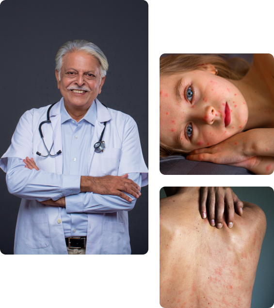 Осложнения после вакцинации от ветряной оспы