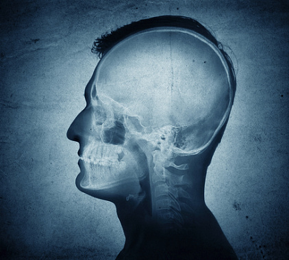 Рентген черепа