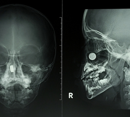 Рентген носоглотки Рентген носоглотки