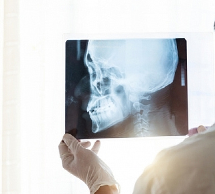 Рентген черепа