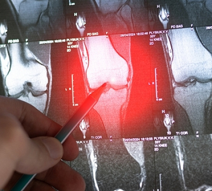 Рентген коленного сустава Рентген коленного сустава