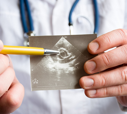 УЗИ брюшной аорты