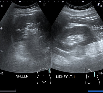 УЗИ селезенки