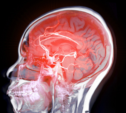 МСКТ сосудов головного мозга МСКТ сосудов головного мозга