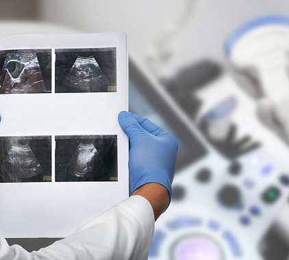 УЗИ селезенки