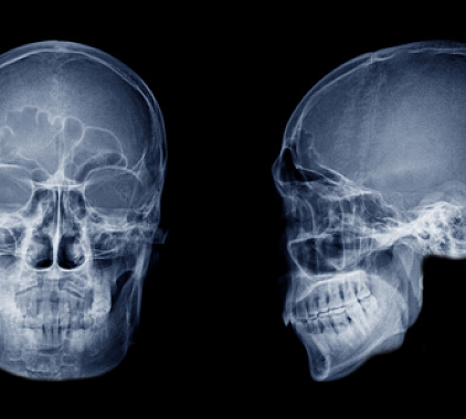 Рентген пазух носа Рентген пазух носа