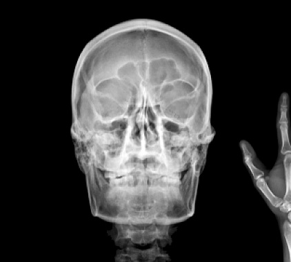 Рентген носоглотки Рентген носоглотки