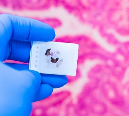 Биопсия Биопсия